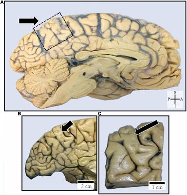 Spindle-Shaped Neurons in the Human Posteromedial (Precuneus) Cortex